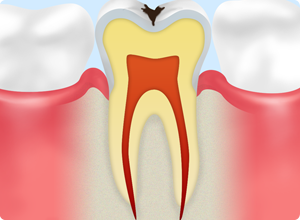 C1：歯の表面の虫歯