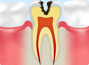 C2：歯の内面の虫歯