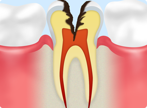 C3：歯の神経にまで進行した虫歯