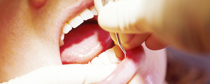 歯周病は早期発見・早期治療が大切です