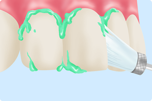 STEP1: 歯のクリーニング